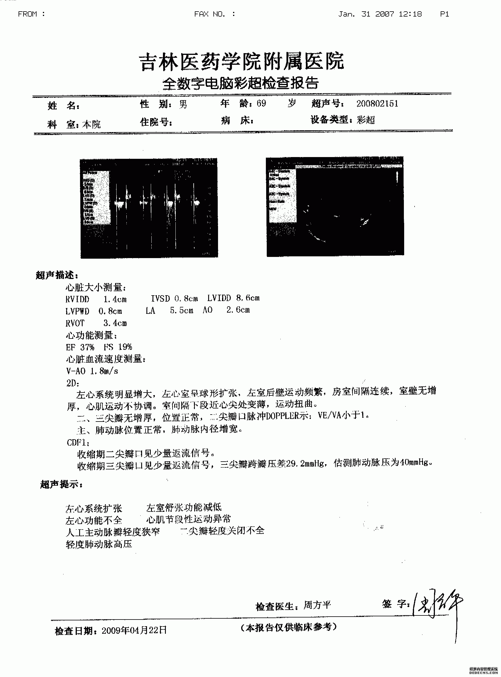 吉林市重症扩心病、心衰心脏回缩 心衰逆转
