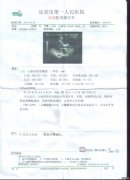 重症扩心病患者、通过1个月治疗扩大的心脏回缩状况