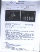 陕西西安市心脏扩大、心衰，病史1年以上案例