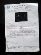 扩张型心肌病伴心力衰竭案例