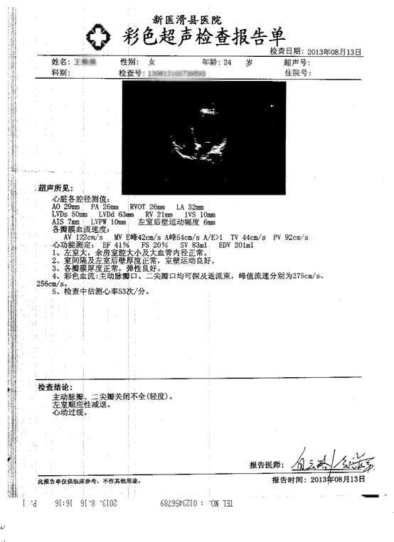 围产期心肌病大心脏能缩小吗