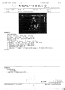 围产期心肌病大心脏能缩小吗 围产期心肌病案例