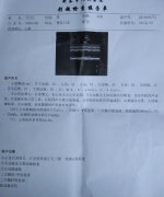 山东泰安扩张性心肌病病史5年心脏缩小真实病例