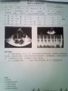 山东省聊城 扩张型心肌病、伴心衰贾主任救治真实病例