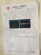 河南省开封扩张型心肌病患者大心脏缩小真实病例