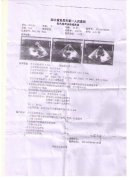 湖北扩张型心肌病、心脏扩大、充血性心力衰竭、严重心律失常患者病例