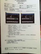 重庆扩张型心肌病患者 3个月治疗后，心脏明显缩小真实病例